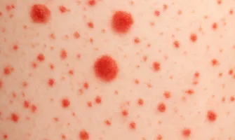 Какво причинява появата на червени петна по кожата?