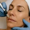 Микронийдлинг – какво представлява процедурата и защо е толкова популярна