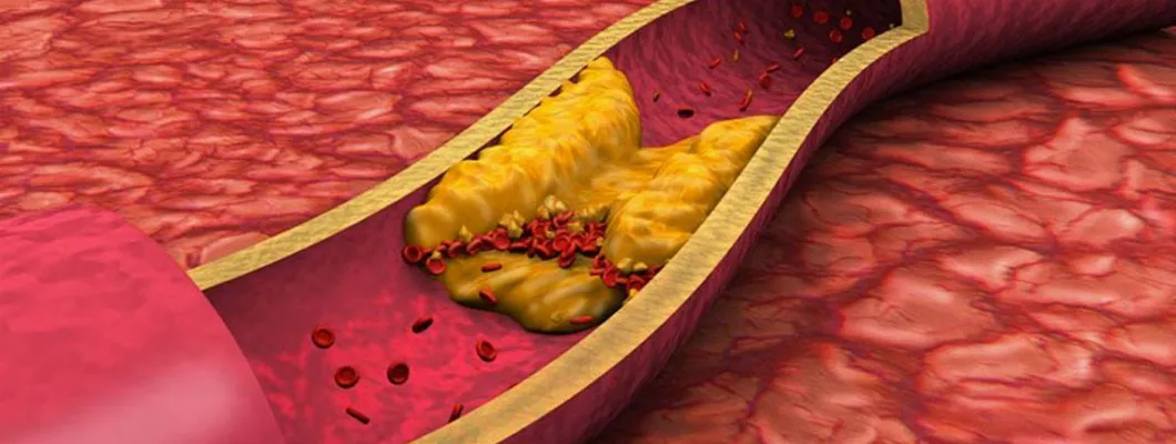 Как да понижим холестерола си – 3 лесни и бързи трика